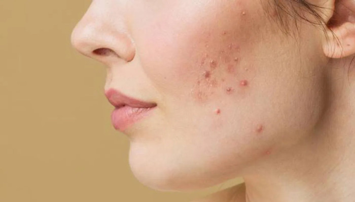 ​ব্রণের কালো দাগ দূর করুন ঘরোয়া উপায়ে