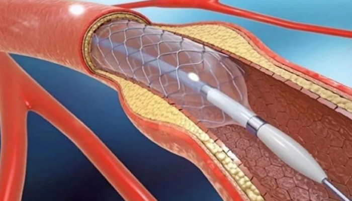 ​হার্টের রিংয়ের দাম কমল