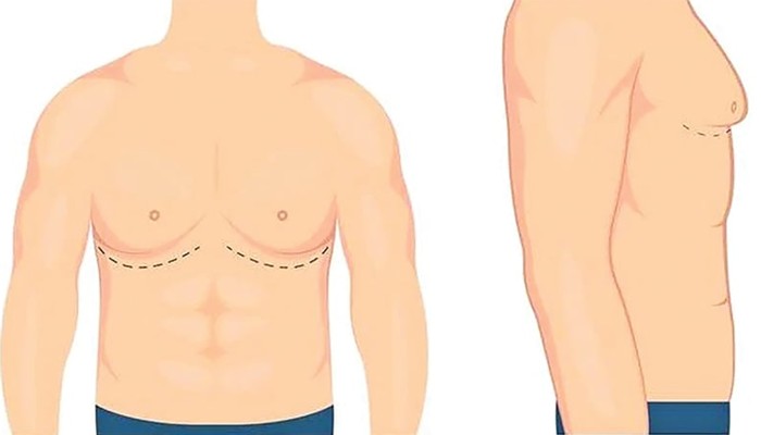 ​পুরুষের স্তন কেন বড় হয়?