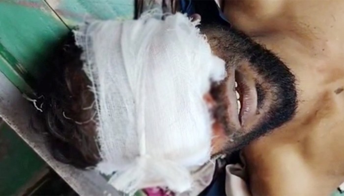 উপড়ে ফেলা হলো অটোরিকশাচালকের চোখ!