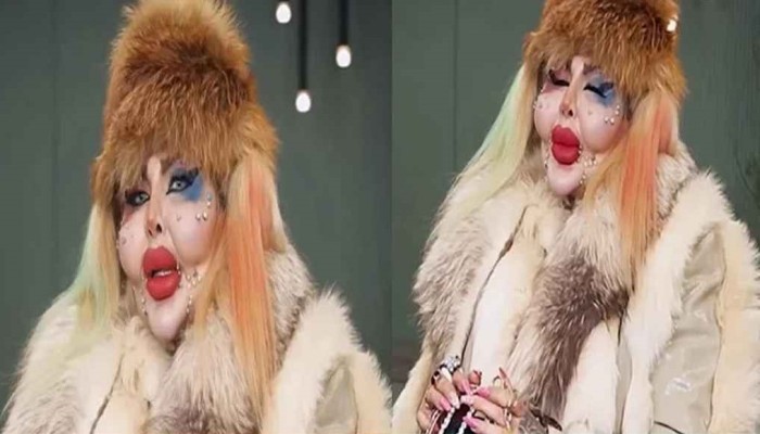 ​চেহারা সুন্দর করতে ৩৮৮ বার প্লাস্টিক সার্জারি, অতঃপর...