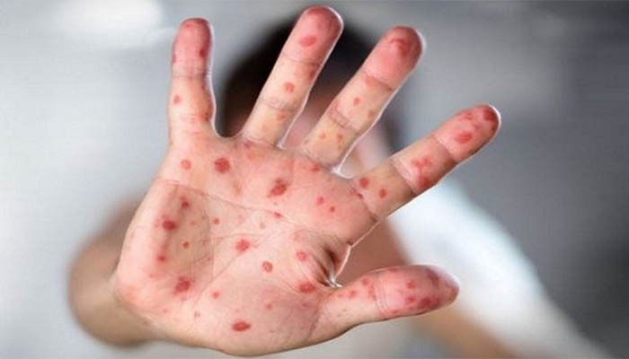 ১৯ দিনে হামের উপসর্গ নিয়ে ৯৪ শিশুর মৃত্যু