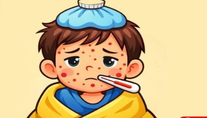 ২৪ ঘণ্টায় হাম ও উপসর্গে আরও ৫ শিশুর মৃত্যু