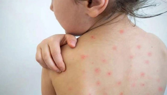 ২৪ ঘণ্টায় হাম ও উপসর্গে আরও ৫ শিশুর মৃত্যু