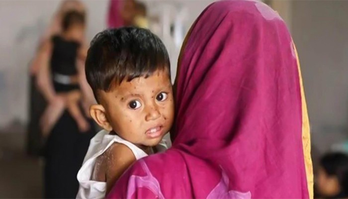 হামের মৃত্যুমিছিলে আরও ৯ শিশু