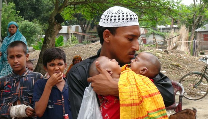 ​ঢামেকের আইসিইউতে জোড়া লাগা যমজ দুই বোনের মৃত্যু