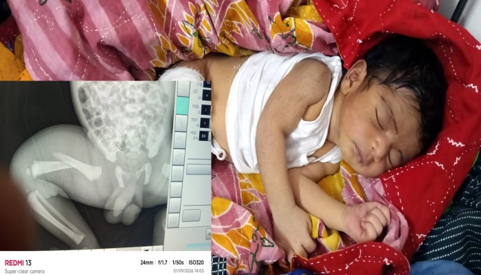 থেরাপি দেওয়ার কথা বলে নবজাতকের পা ভাঙলেন নার্স