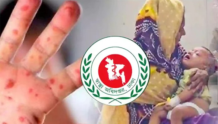 হাম ও উপসর্গে মৃত্যু হাজার ছাড়াল, আক্রান্ত পৌনে দুই লাখ